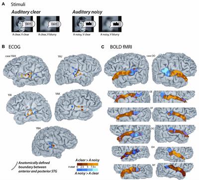 Converging Evidence From Electrocorticography and BOLD fMRI for a Sharp Functional Boundary in Superior Temporal Gyrus Related to Multisensory Speech Processing
